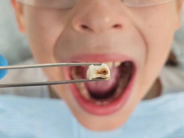 Best Emergency Treatment for Toothache in Milton, PA